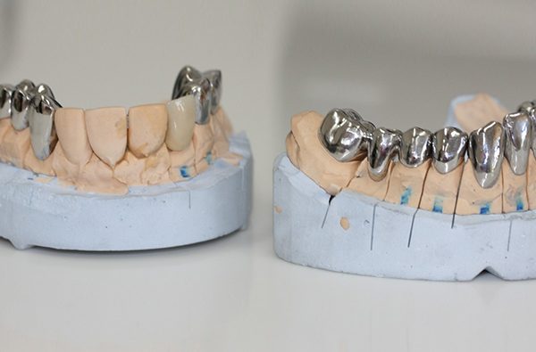 Metal-crowns-3-2